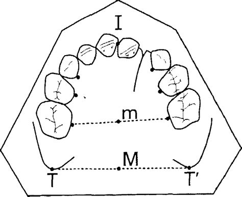 Figure 3 from Supraperiosteal Flap Technique versus Mucoperiosteal Flap ...