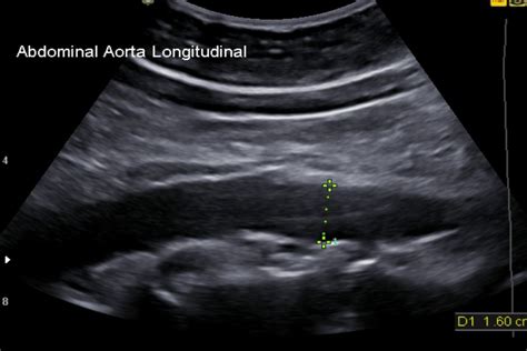 Abdominal Aorta Ultrasound