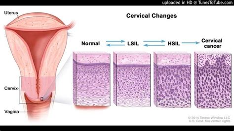 Cervical squamous intraepithelial neoplasia, CIN, conization, LEEP ...