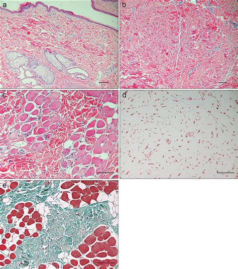 Histologic section of fibromatosis in a Bernese Mountain Dog. A ...