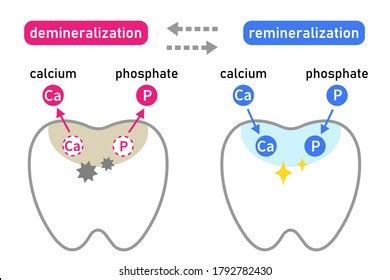 92 Tooth Demineralization Images, Stock Photos & Vectors | Shutterstock