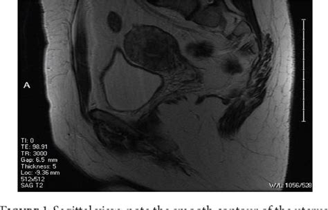 Figure 1 from A Rare Mullerian Duct Anomaly Not Included in the Classification System by the ...