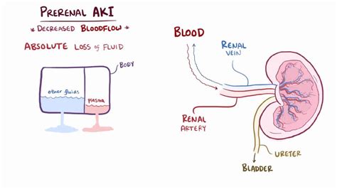 Prerenal azotemia: Video, Anatomy & Definition | Osmosis