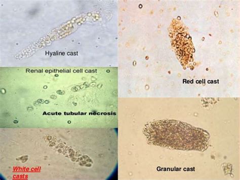 white cell casts - Google Search | Medical laboratory science, Medical laboratory, Laboratory ...