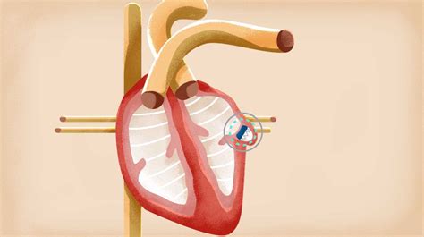 Aultman Performs First Watchman Heart Procedure » Aultman