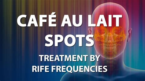 Café au Lait Spots (Macules) - RIFE Frequencies Treatment - Energy & Quantum Medicine ...