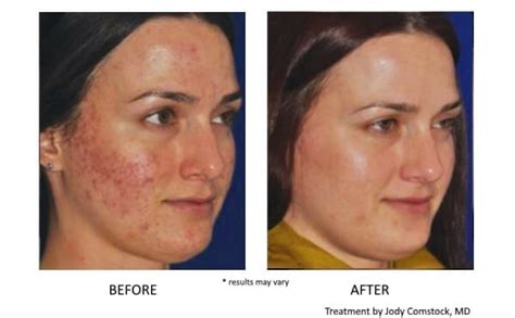 prp-facial-before-and-after-2 - Amy A. Vaughan, M.D. Dermatology