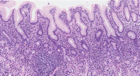 Atrophic Gastritis Histology