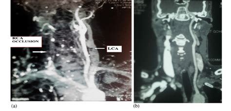 (a and b) Angiography: complete occlusion of the right ICA (LCA= left ...