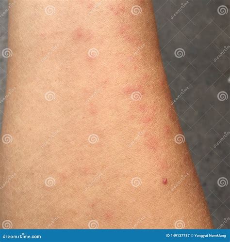 Rash Caused by Skin Allergic To Sweat, Dust and Viruses. Stock Image - Image of complexion ...