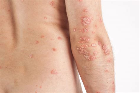 Psoriasis | Plaque Psoriasis