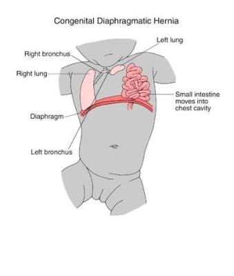 Congenital Diaphragmatic Hernia - Fetal Health Foundation