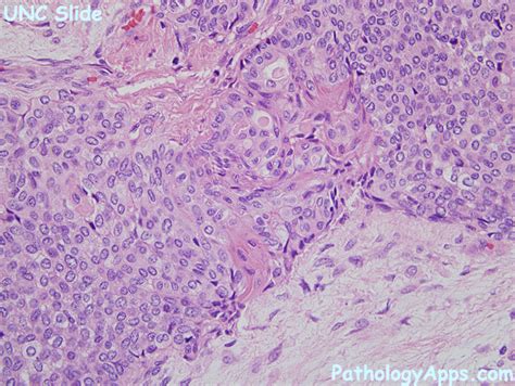 pleomorphic adenoma pathology