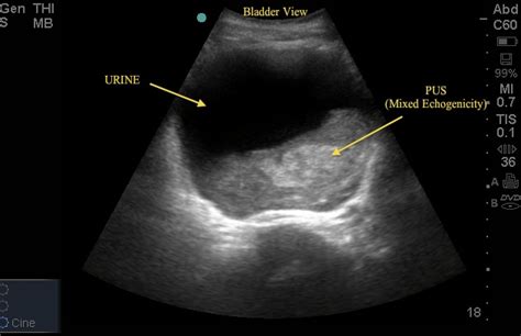 Urinary Retention ~ Ultrasound Cases Info