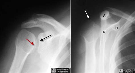 Learning Radiology - Dislocation, Shoulder, posterior