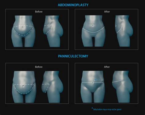 Panniculectomy » UF Health Plastic Surgery and Aesthetics Center » UF Academic Health Center ...