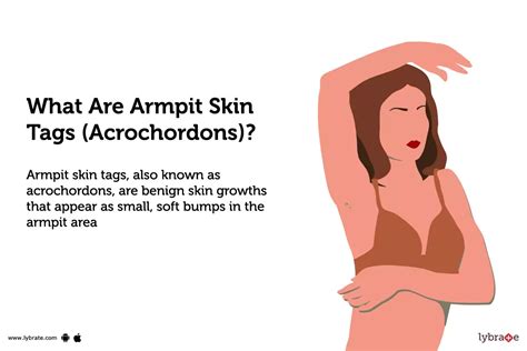 Armpit skin tags (acrochordons): Causes, Symptoms, Treatment and Cost