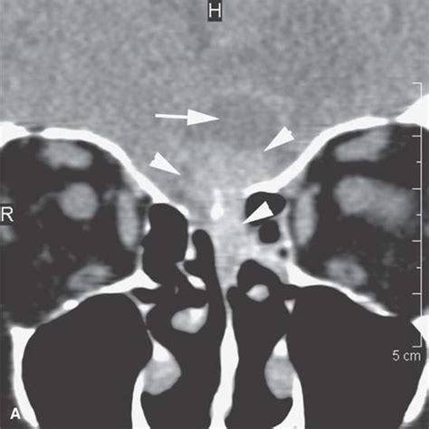 Benign and Malignant Neuroectodermal and Other Neurogenic Tumors ...