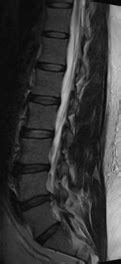 T2 Sagittal MRI Lumbar Spine: L4-L5 left paracentral disc protrusion... | Download Scientific ...