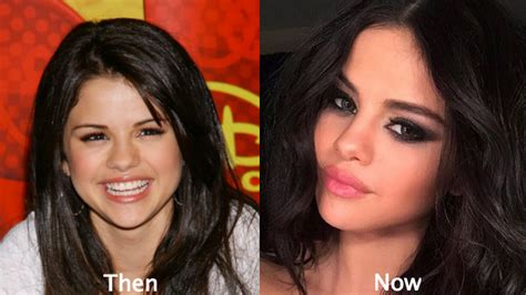 Selena Gomez Plastic Surgery Before and After Photos