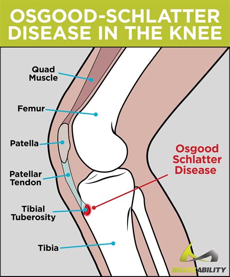 Pin on Knee Replacement