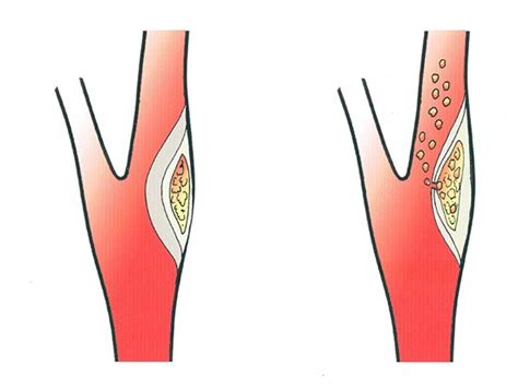 Carotid Artery Blockage. carotid artery blockage surgery, carotid artery blockage symptoms pain