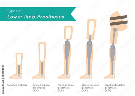 Prosthetic Limb Types - Design Talk