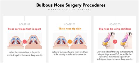 Bulbous Nose: Definition and procedures