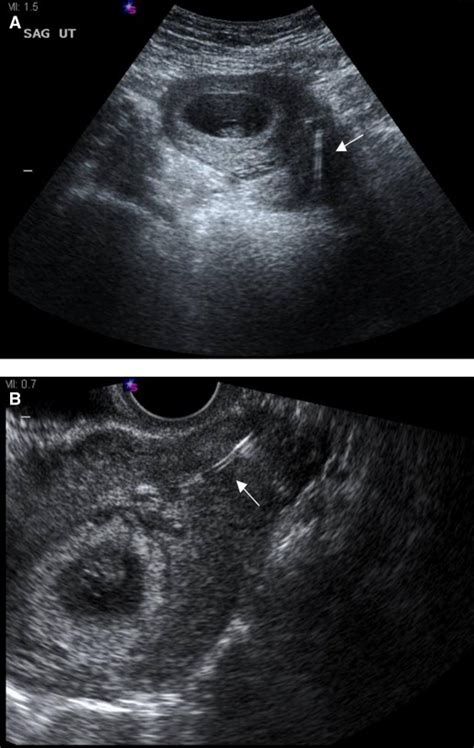 Intrauterine devices in early pregnancy: findings on ultrasound and ...