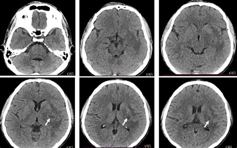 Cerebral abscess – Radiology Cases