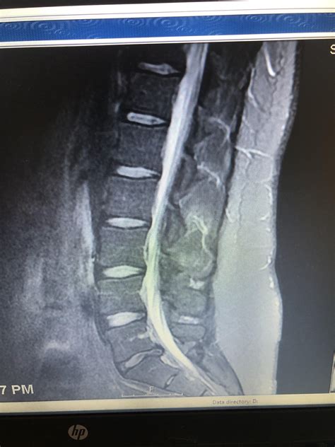 My L5/S1 herniated disc due to degenerative disc disease. : r/Sciatica