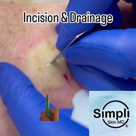 Abscess/Boil Incision & Drainage - YouTube