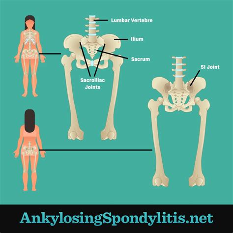 does ankylosing spondylitis get worse with age - Hyo Morrill