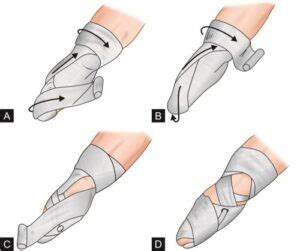 Below elbow amputation: Indication, Prosthesis, Treatment