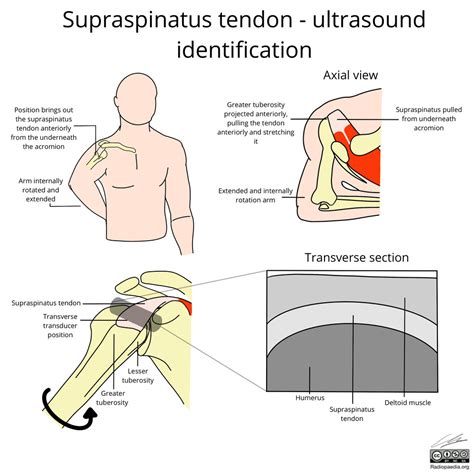 Supraspinatus Stretch