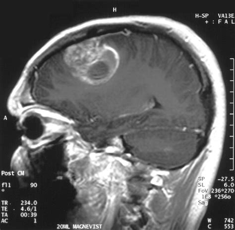 Brain Tumors: How Surgeons are Operating on the Inoperable | Clinical And Molecular Dx