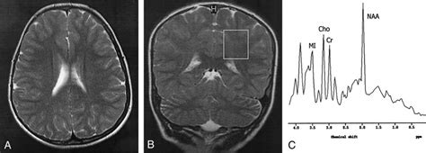 Findings in an 8-year-old girl with stage II SSPE. A, Axial T2-weighted ...