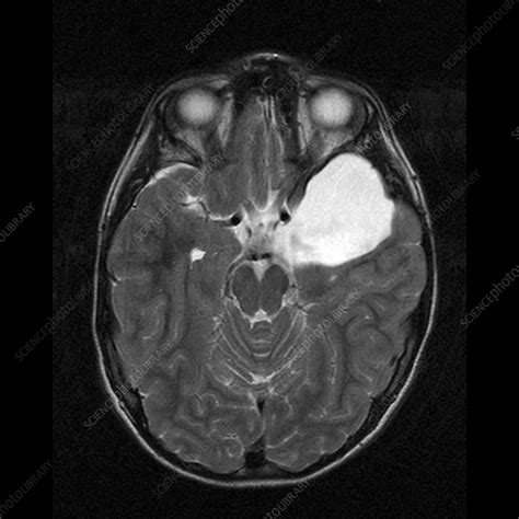 Arachnoid Cyst, MRI scan - Stock Image - M130/0944 - Science Photo Library