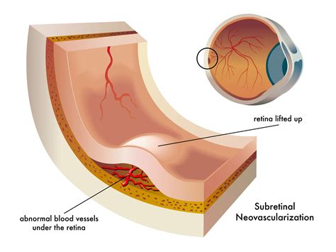 Wet Macular Degeneration: Symptoms, Treatment, and Research Updates