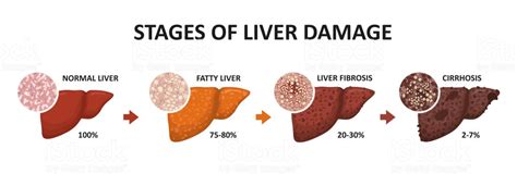 Everything You Need To Know About Cirrhosis: The Liver Killer