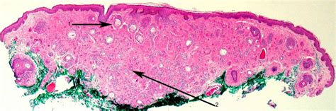 Ocular Pathology: What is syringoma?