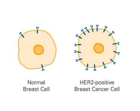 What Is HER2-Positive Breast Cancer? | Dana-Farber Cancer Institute