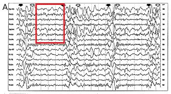 Electroencephalogram (EEG) Seizure Test: Patterns & Detection | Study.com