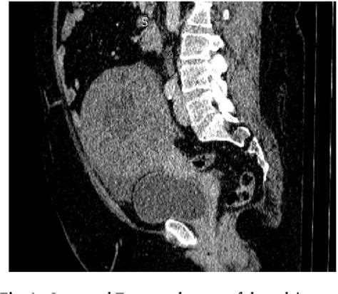 Figure 1 from Double neuraxial catheter (Subarachnoid and epidural) in ...