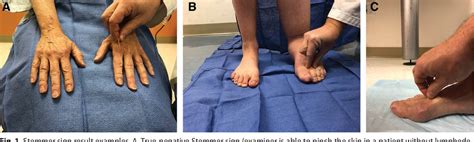 Sensitivity and Specificity of the Stemmer Sign for Lymphedema: A ...