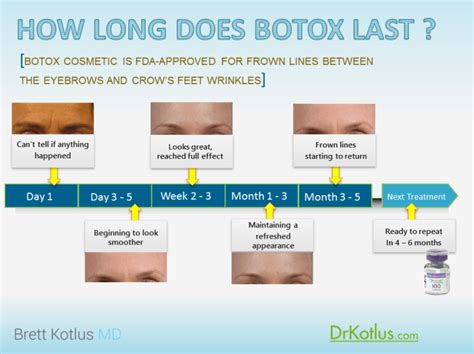 How Long Does Botox Last? | Dr. Brett Kotlus, Cosmetic Oculoplastic ...