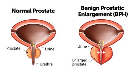 Causes of Prostate Enlargement and tips to maintain Prostate Health ...