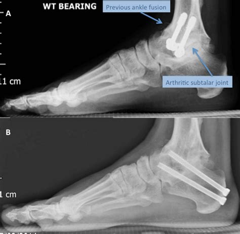 Subtalar Arthritis | Arthritis Of The Subtalar Joint | LFAC (2022)