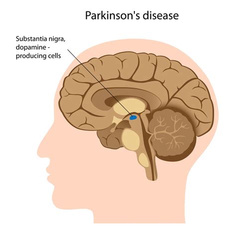 Parkinson’s Disease - stemcellreference