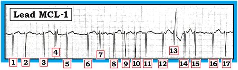 ECG Interpretation: July 2013